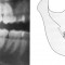 verlagerter Weisheitszahn