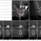 Dreidimensionale Implantatplanung im Unterkiefer